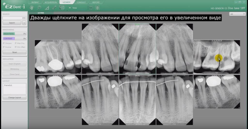 радиовизиограф стоматологический. снимок на визиографе